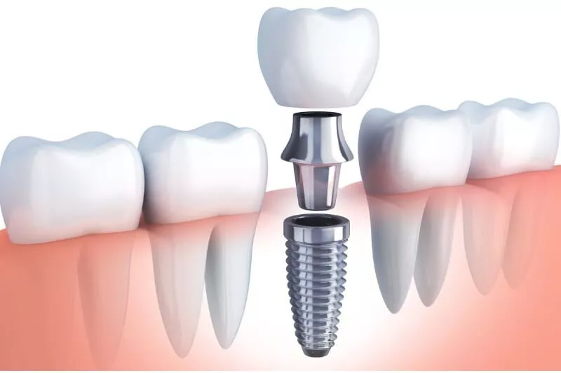 implants